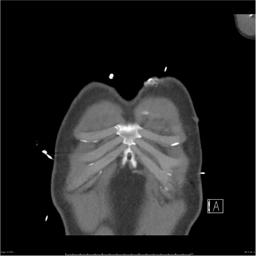 Azygos venous system anatomy (CT pulmonary angiography) (Radiopaedia 25928-26077 Coronal C+ CTPA 4).jpg