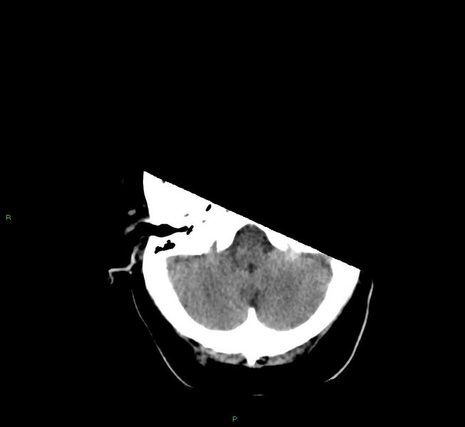File:Basal ganglia hemorrhage (Radiopaedia 58759-65981 Axial non-contrast 42).jpg