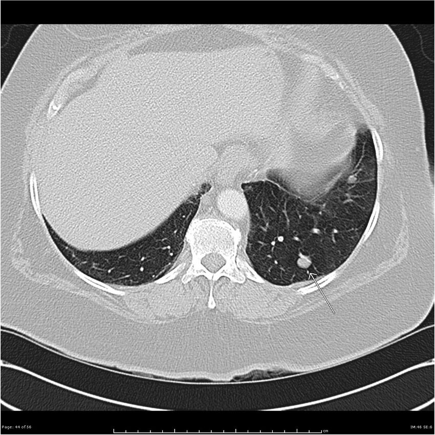 Benign metastasizing leiomyoma (Radiopaedia 26803-26962 Axial lung window 44).jpg