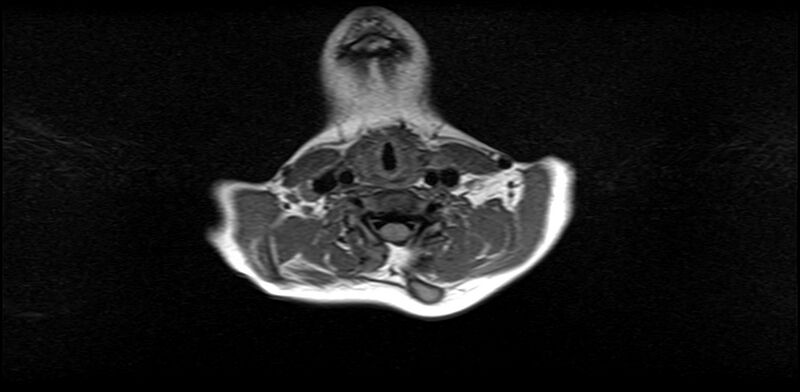File:Bilateral Sprengel deformity with Klippel-Feil syndrome (Radiopaedia 66395-75650 Axial T1 14).jpg