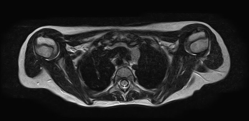 File:Bilateral Sprengel deformity with Klippel-Feil syndrome (Radiopaedia 66395-75650 Axial T2 24).jpg