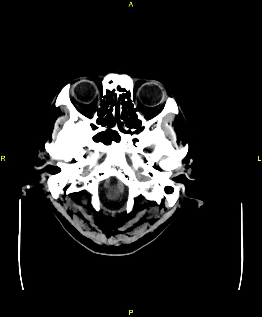 Bilateral isodense subdural hematomas (Radiopaedia 88621-105325 Axial non-contrast 10).jpg