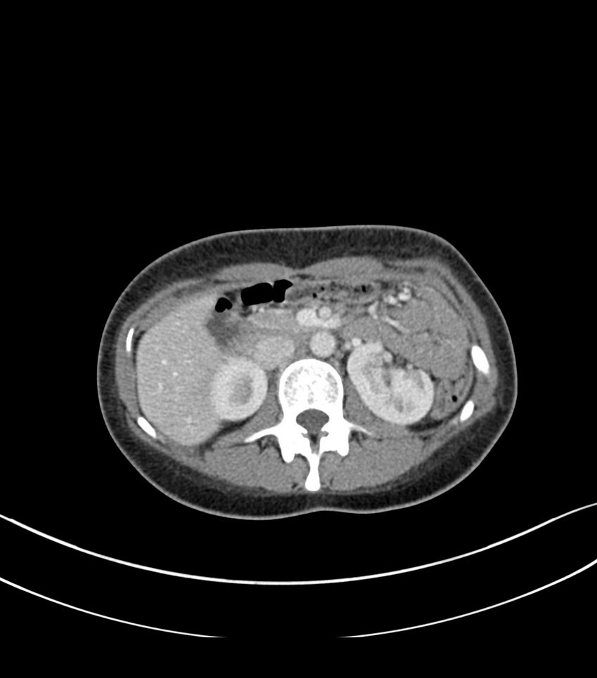 Bilateral kidney malrotation (Radiopaedia 72227-82749 A 18).jpg
