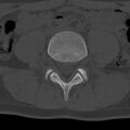 Bilateral pars defect (Radiopaedia 26691-26846 Axial bone window 37).jpg