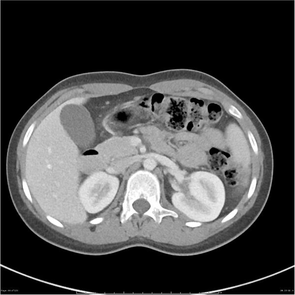 File:Bilateral ureteritis and cystitis (Radiopaedia 25340-25594 A 23).jpg