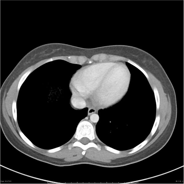 File:Bilateral ureteritis and cystitis (Radiopaedia 25340-25594 A 3).jpg