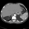 Biliary necrosis - liver transplant (Radiopaedia 21876-21845 A 11).jpg