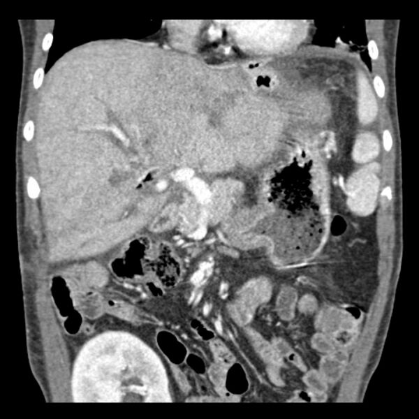 File:Biliary necrosis - liver transplant (Radiopaedia 21876-21846 C 19).jpg