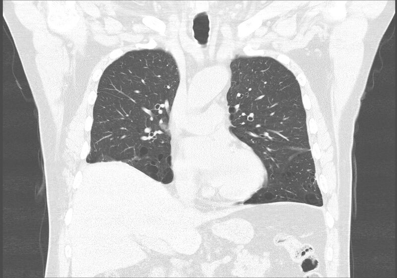 File:Birt-Hogg-Dubé syndrome (Radiopaedia 52578-58491 Coronal lung window 23).jpg