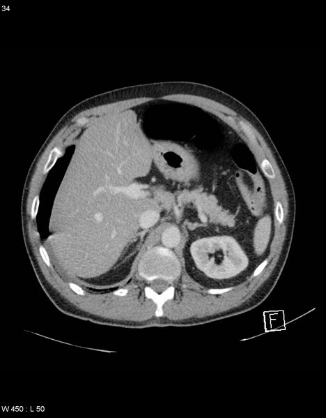 File:Boerhaave syndrome with tension pneumothorax (Radiopaedia 56794-63603 A 17).jpg