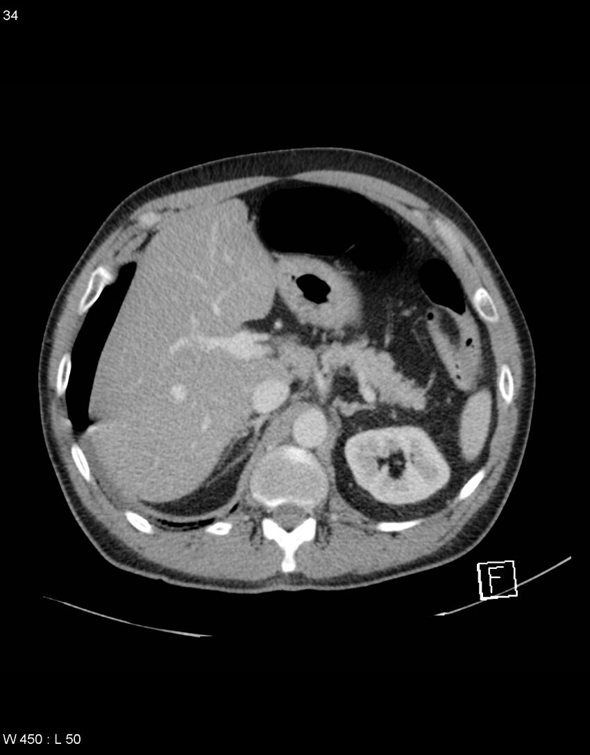 Boerhaave syndrome with tension pneumothorax (Radiopaedia 56794-63603 A 17).jpg
