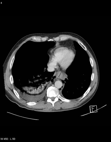 File:Boerhaave syndrome with tension pneumothorax (Radiopaedia 56794-63603 A 2).jpg