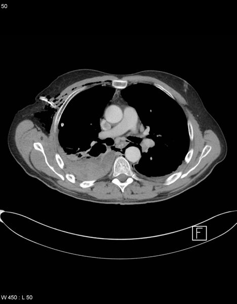 File:Boerhaave syndrome with tension pneumothorax (Radiopaedia 56794-63605 A 24).jpg
