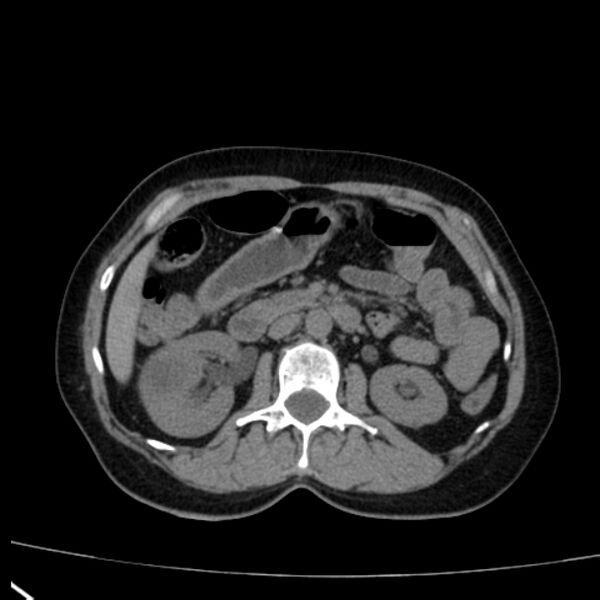 File:Bosniak renal cyst - type I (Radiopaedia 27479-27675 Axial non-contrast 37).jpg