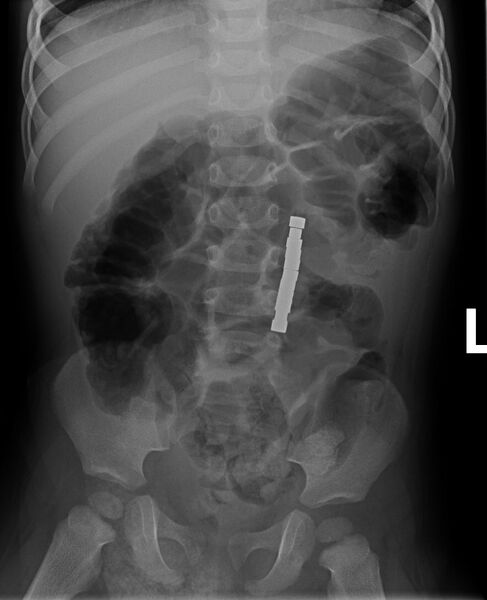 File:Bowel perforation after ingestion of magnets (Radiopaedia 55587).jpg
