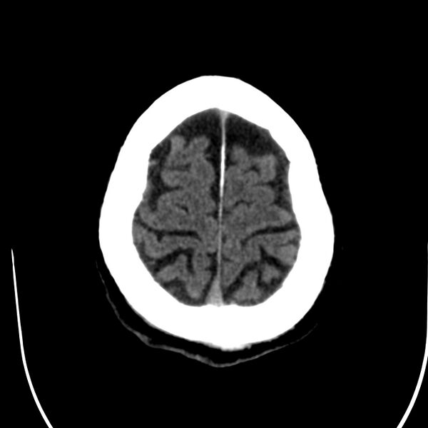 File:Brain Pantopaque remnants (Radiopaedia 78403-91048 Axial non-contrast 79).jpg
