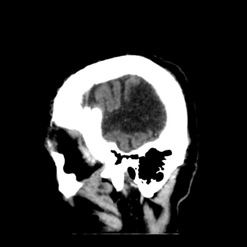 Brain Pantopaque remnants (Radiopaedia 78403-91048 C 7).jpg