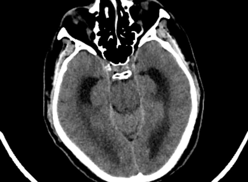 File:Brain abscess complicated by intraventricular rupture and ventriculitis (Radiopaedia 82434-96575 Axial non-contrast 10).jpg