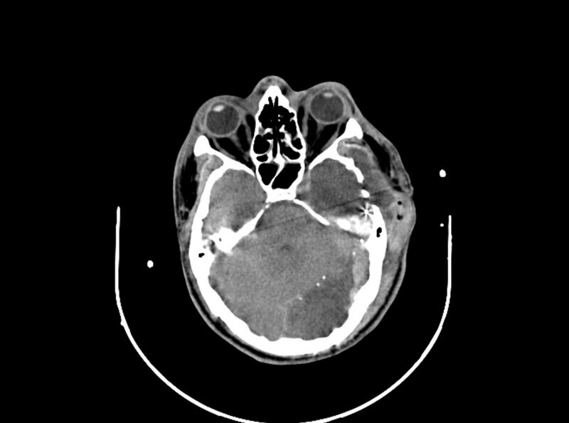 File:Brain injury by firearm projectile (Radiopaedia 82068-96087 B 76).jpg