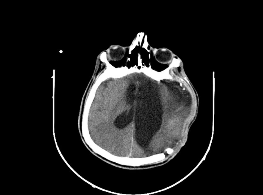 Brain injury by firearm projectile (Radiopaedia 82068-96088 A 132).jpg