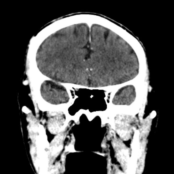 File:Brain metastases from lung cancer (Radiopaedia 27849-28092 Coronal C+ delayed 21).jpg