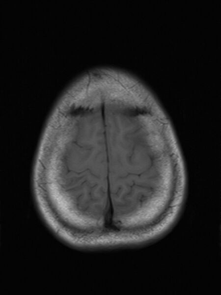 File:Brain metastasis as initial presentation of non-small cell lung cancer (Radiopaedia 65122-74126 Axial T1 17).jpg