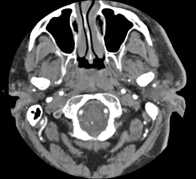 File:Brainstem hemorrhage (Radiopaedia 58794-66028 D 19).jpg