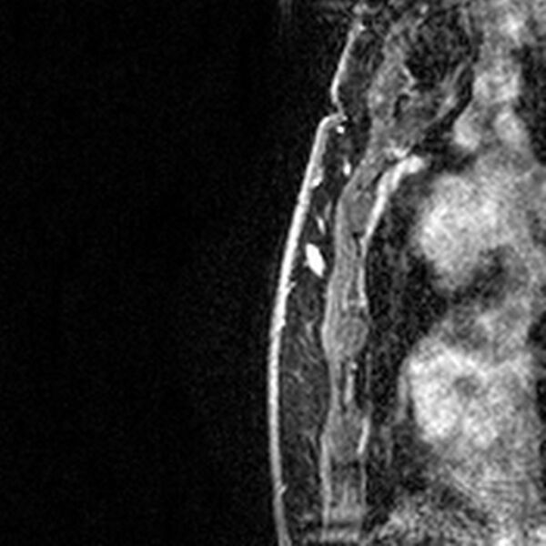 File:Breast implants - MRI (Radiopaedia 26864-27035 Sagittal T2 77).jpg