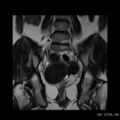 Broad ligament fibroid (Radiopaedia 49135-54241 Coronal T2 17).jpg