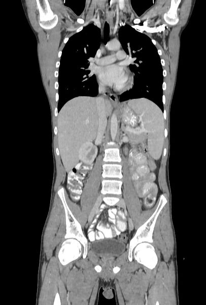 File:Bronchial carcinoid tumor (Radiopaedia 57187-64090 B 50).jpg