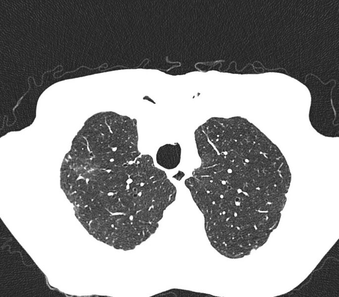 File:Bronchiolitis (Radiopaedia 24616-24887 Axial lung window 7).jpg