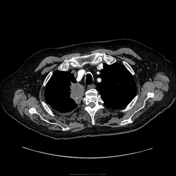 File:Bronchogenic adenocarcinoma and pulmonary embolism (Radiopaedia 9097-9806 D 15).jpg