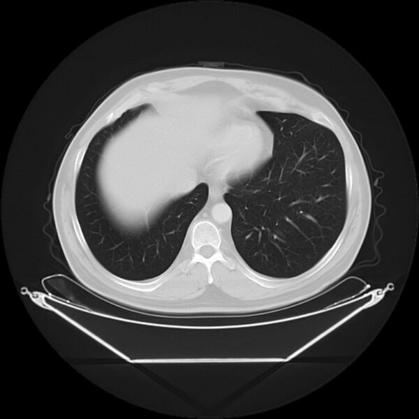 File:Bronchogenic carcinoma with upper lobe collapse (Radiopaedia 29297-29726 Axial lung window 26).jpg