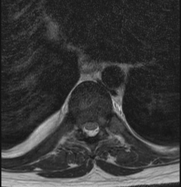 File:Brown tumors compressing the spinal cord (Radiopaedia 68442-78030 A 23).jpg