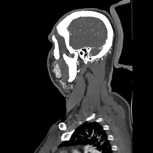 File:Buccal fat pad arteriovenous malformation (Radiopaedia 70936-81144 C 30).jpg