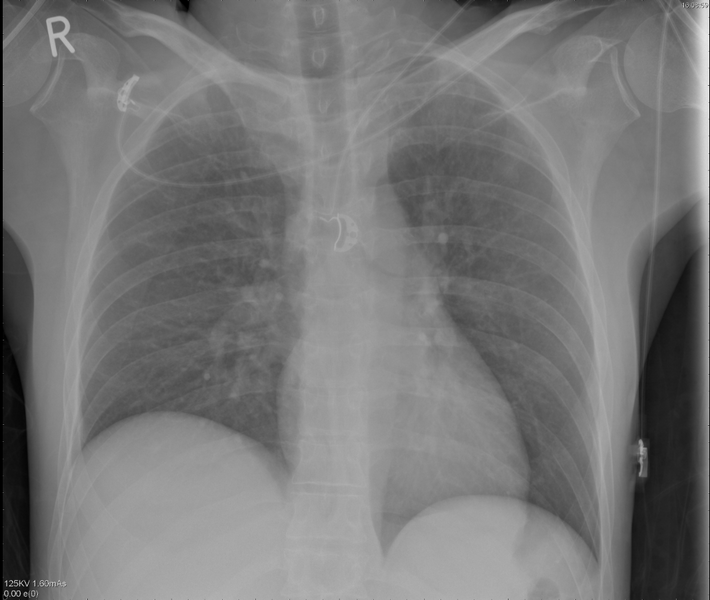 File:Bulging of paraspinal line in traumatic thoracal spinal compression fracture (Radiopaedia 29221-33631 AP 1).png