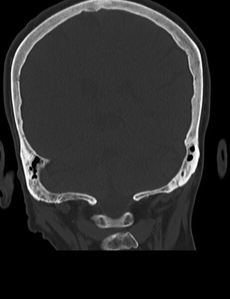 File:Burnt-out meningioma (Radiopaedia 51557-57337 Coronal bone window 37).jpg
