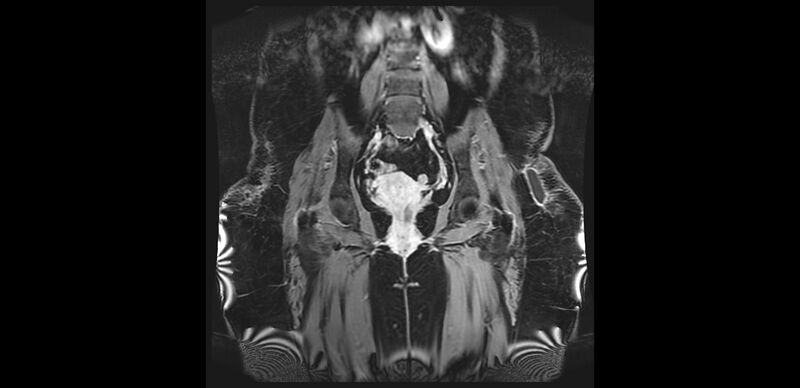 File:Buttock filler complications (Radiopaedia 63497-72115 Coronal T1 C+ 25).jpg