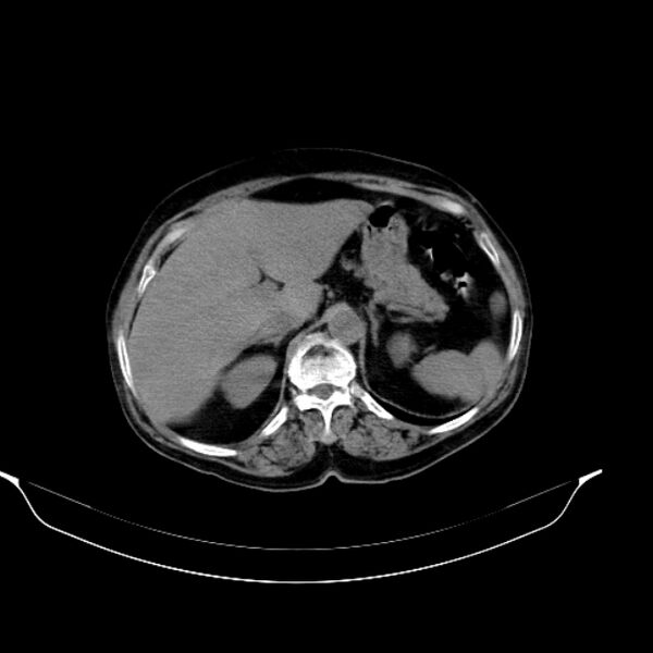 File:Calcified hydatid cyst (Radiopaedia 62000-70085 Axial non-contrast 32).jpg