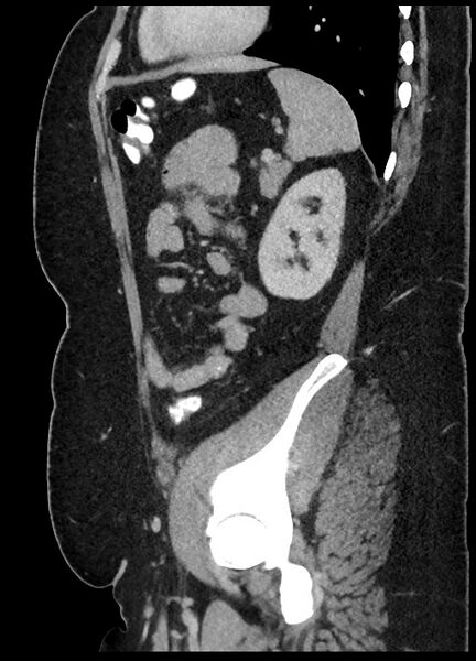 File:Carcinoid tumor - terminal ileum (Radiopaedia 60931-68739 C 21).jpg