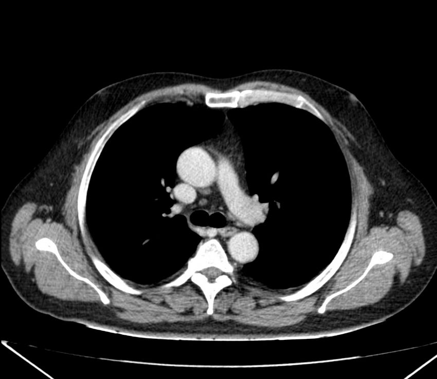 Carcinoid tumor with hepatic metastases (Radiopaedia 22651-22670 C 13).jpg