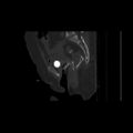 Carcinoma cervix- brachytherapy applicator (Radiopaedia 33135-34173 Sagittal bone window 102).jpg