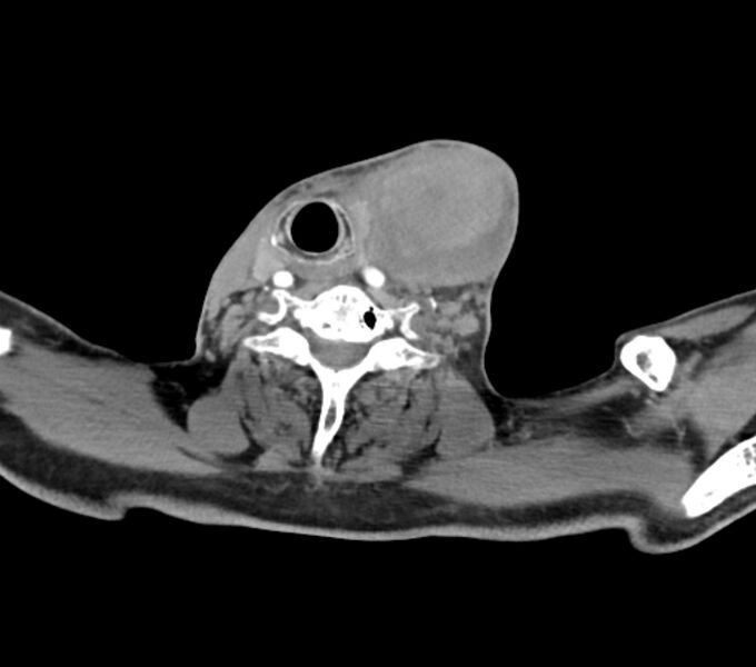 File:Carotid artery pseudoaneurysm (Radiopaedia 84030-99259 C 58).jpg