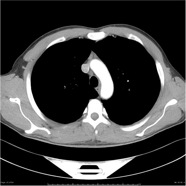 File:Cavitating lung cancer (Radiopaedia 25796-25945 C+ arterial phase 15).jpg