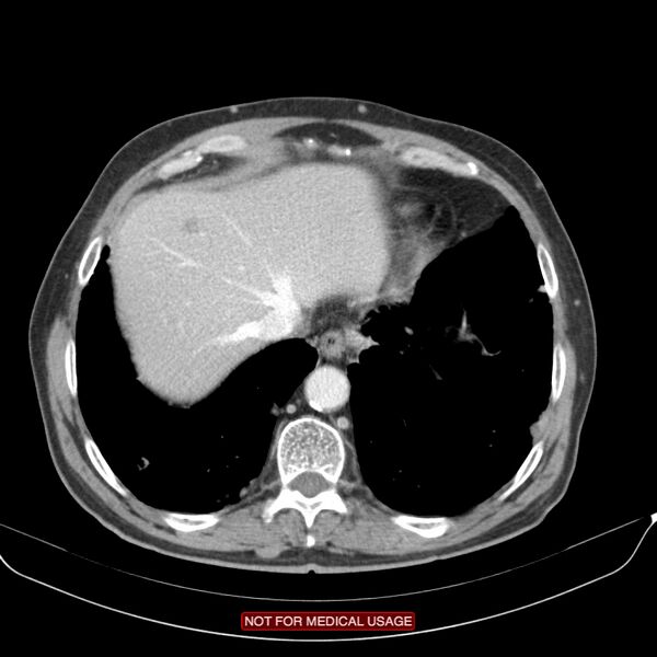 File:Cavitating pulmonary metastases (Radiopaedia 24920-25184 B 24).jpg
