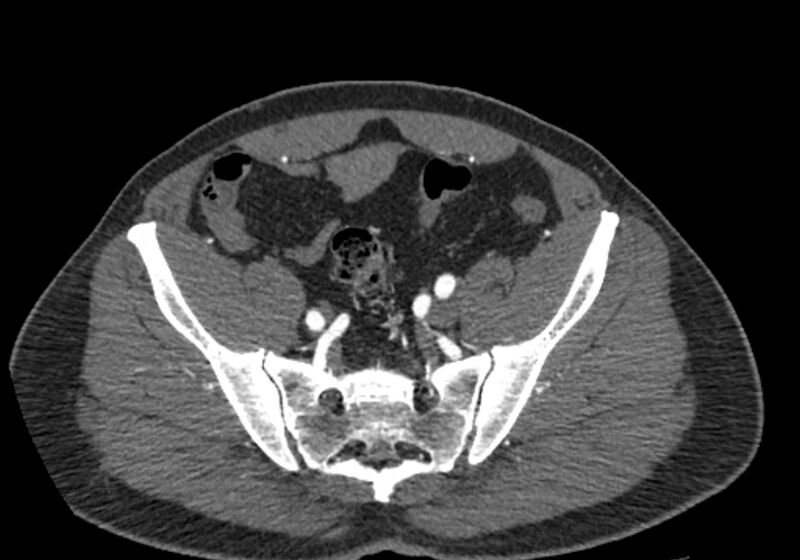 File:Celiac artery dissection (Radiopaedia 52194-58080 A 94).jpg