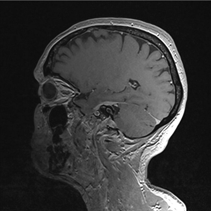 Central base of skull meningioma (Radiopaedia 53531-59549 Sagittal T1 C+ 52).jpg