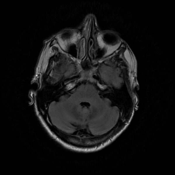 File:Central neurocytoma (Radiopaedia 67618-77021 Axial FLAIR 7).jpg
