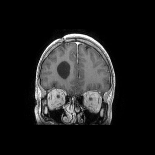 File:Central neurocytoma (Radiopaedia 67618-77021 Coronal T1 C+ 26).jpg