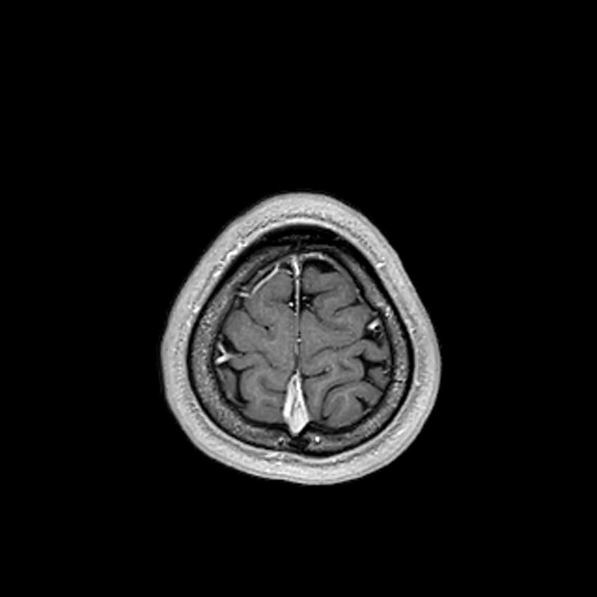 Central neurocytoma (Radiopaedia 79320-92380 Axial T1 C+ 211).jpg